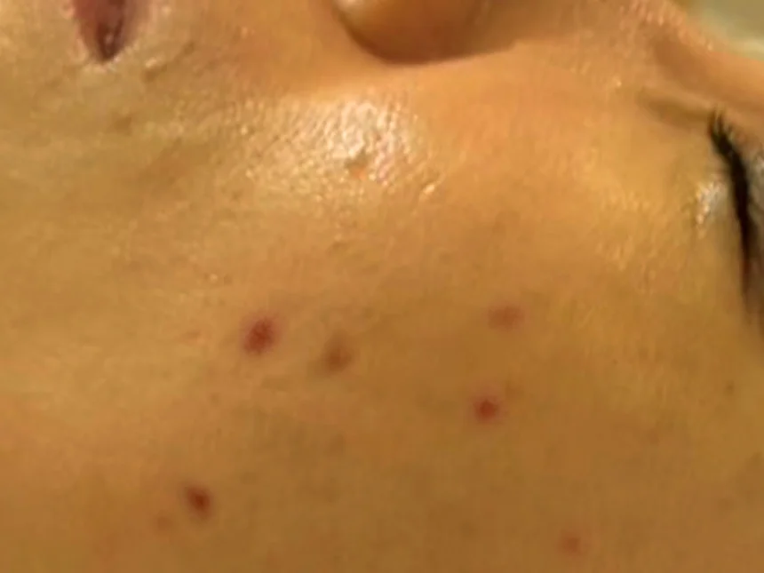 ニキビケア 施術前