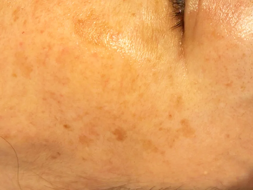 シミ・肝斑ケア 施術後