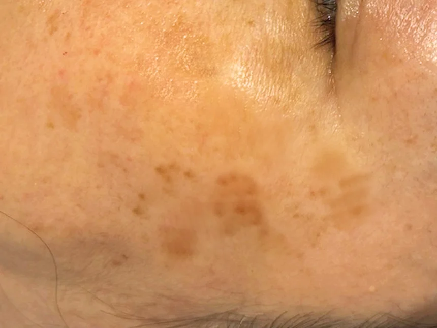 シミ・肝斑ケア 施術前